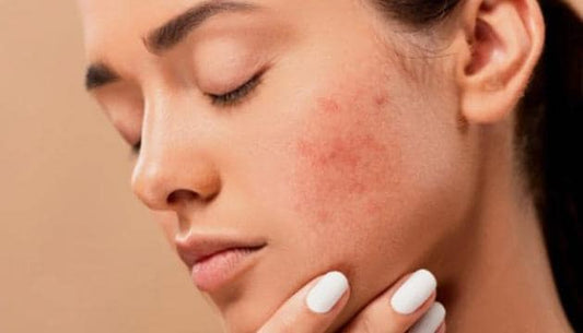 How to Treat Dry Skin
