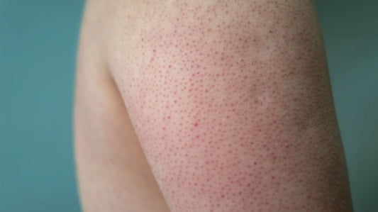 How to clear strawberry legs -- Keratosis Pilaris